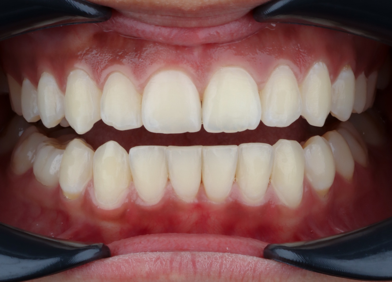 Antes · diseño de sonrisa en resina