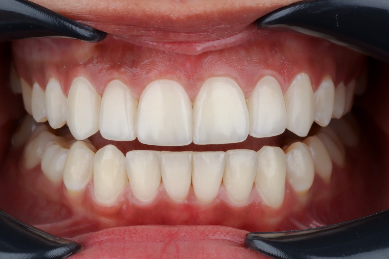 Después · diseño de sonrisa en resina