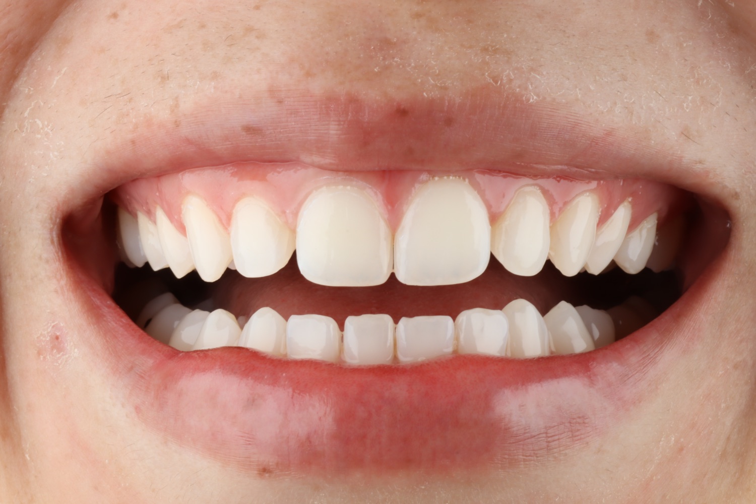 Antes · diseño de sonrisa en resina