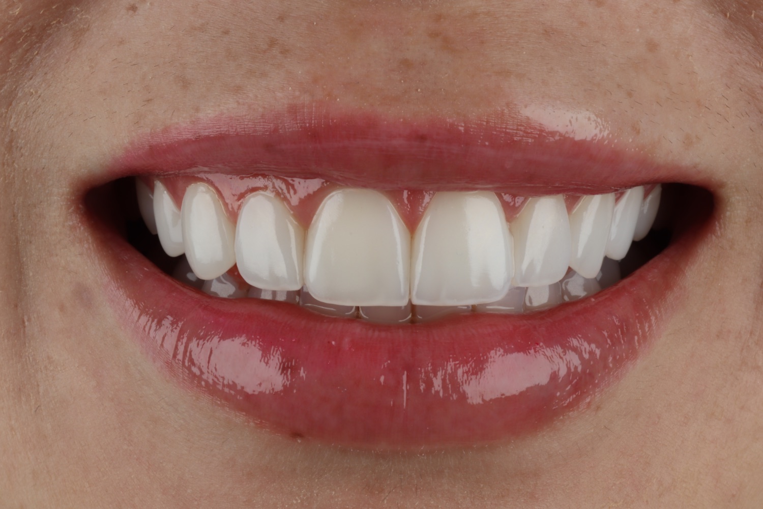 Después · diseño de sonrisa en resina